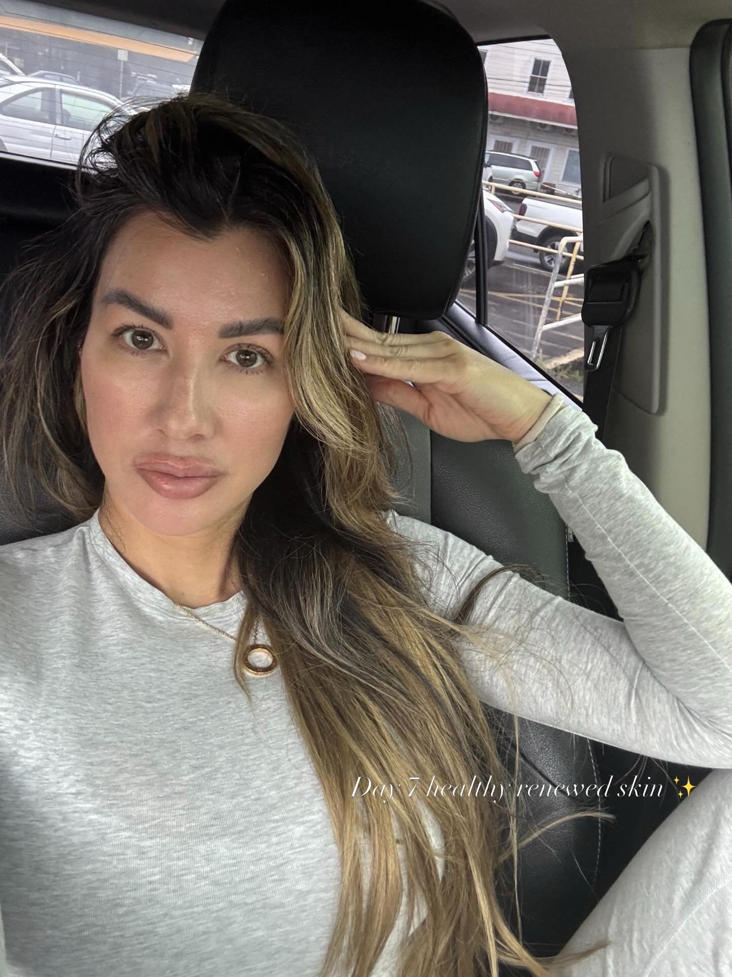 swipe to see the peeling ➡️

A few weeks ago I did the @mariniskinsolutions Clarify Peel and trusted the process through the shedding phase

this professional peel targets acne, congestion, texture, and discoloration by accelerating cell turnover and