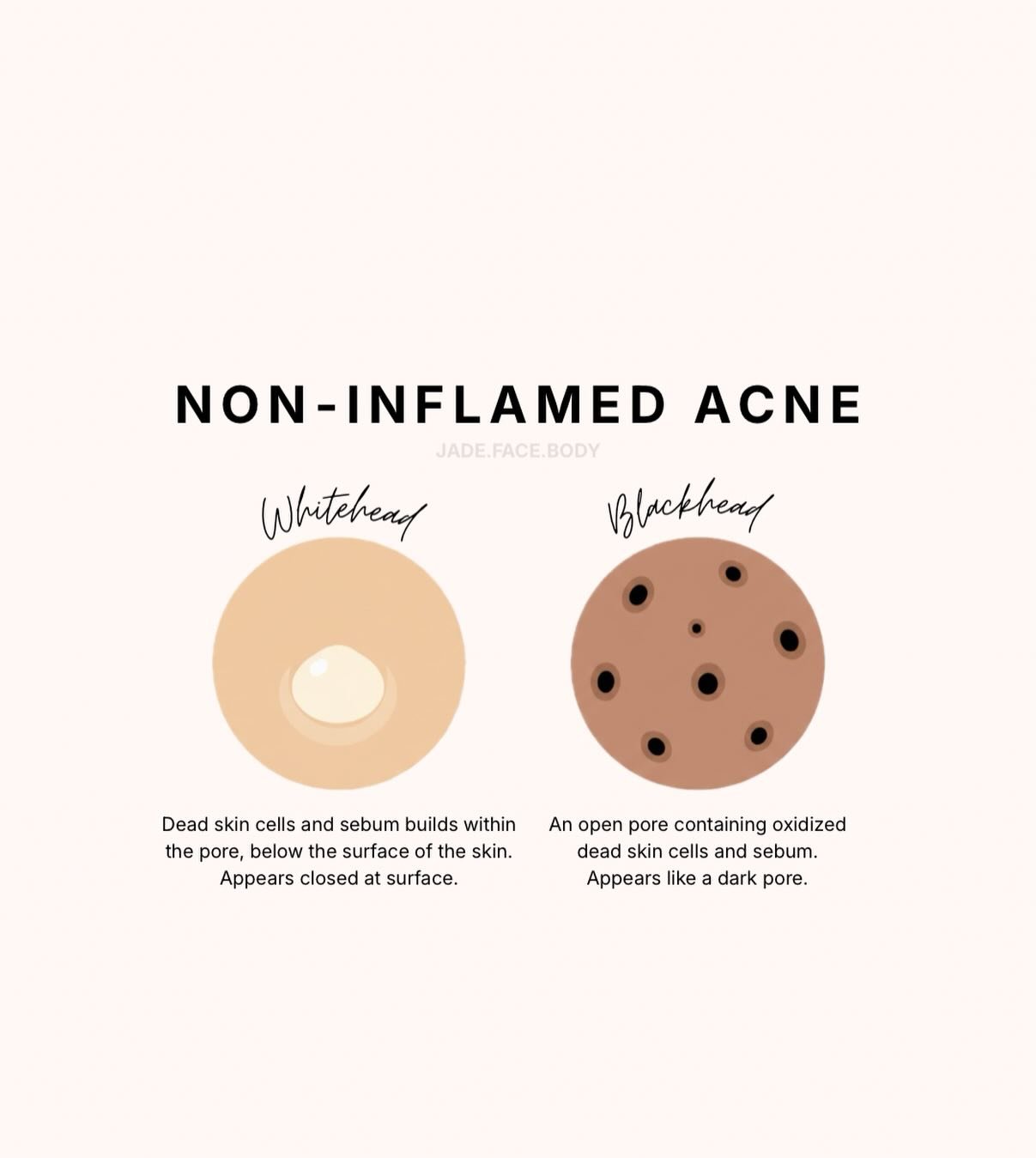 Not all acne is the same so why treat it the same&hellip;

✨ Non-inflamed acne
&bull; Blackheads + whiteheads
&bull; No redness or pain
&bull; Caused by clogged pores (oil + dead skin buildup)
&bull; Best treated with exfoliation + retinoids

🔥 Infl
