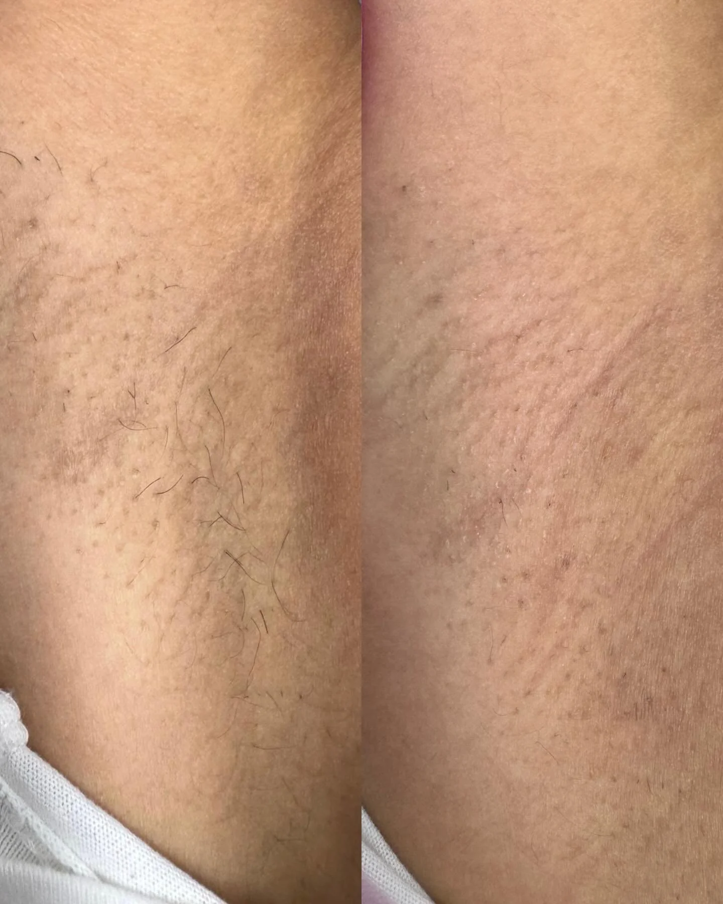 Laser hair removal now = smooth skin by spring break👙

A little redness after treatment? That&rsquo;s called erythema and it&rsquo;s completely normal

Erythema is temporary redness caused by heat targeting the hair follicle. It actually tells us th