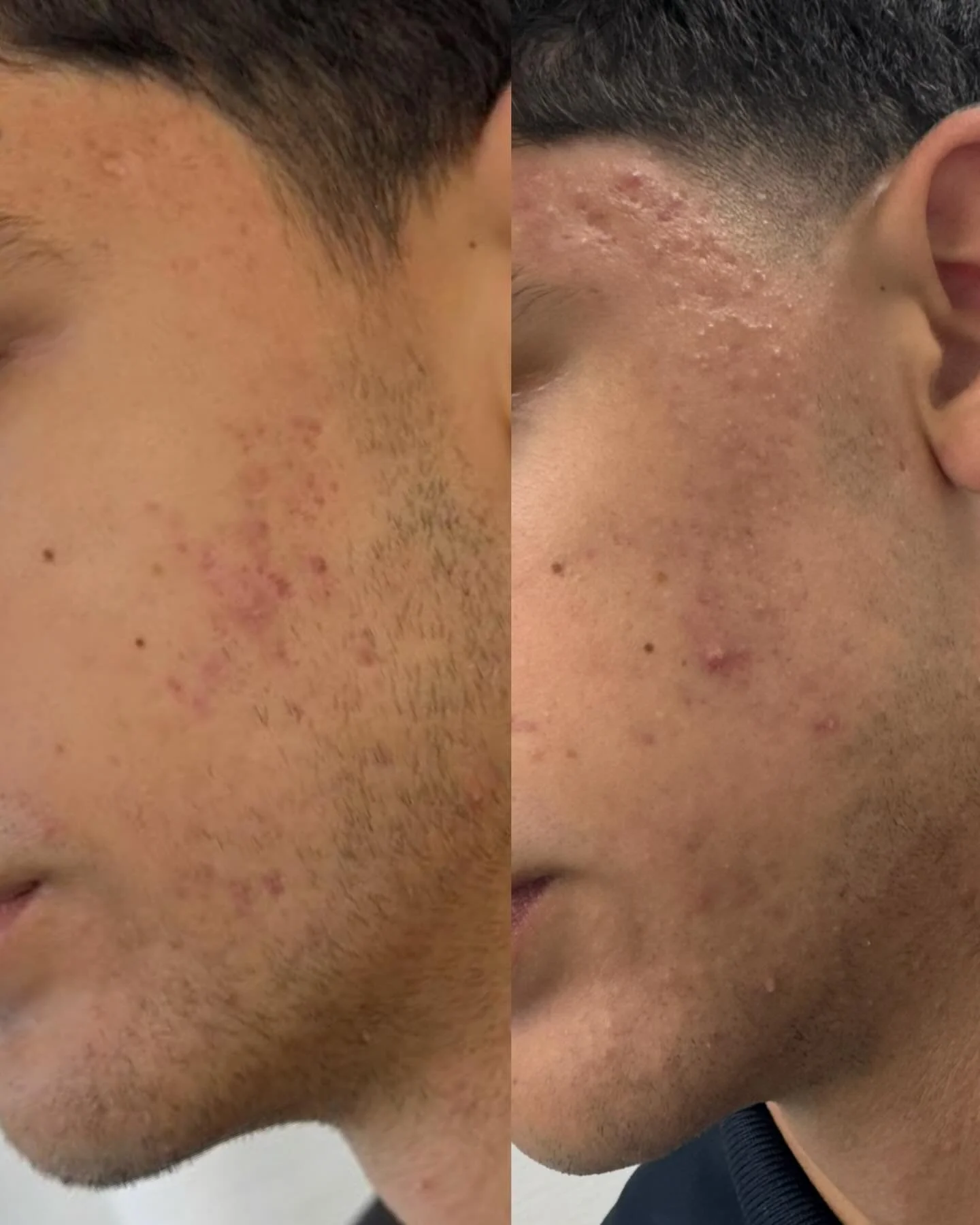 Aerolase Neo Elite is changing the game in acne care 🔥

No harsh topicals. No downtime. No intense side effects.

Just a gentle, effective, all-in-one laser treatment that targets everything active breakouts, inflammation, post-acne marks, and even 