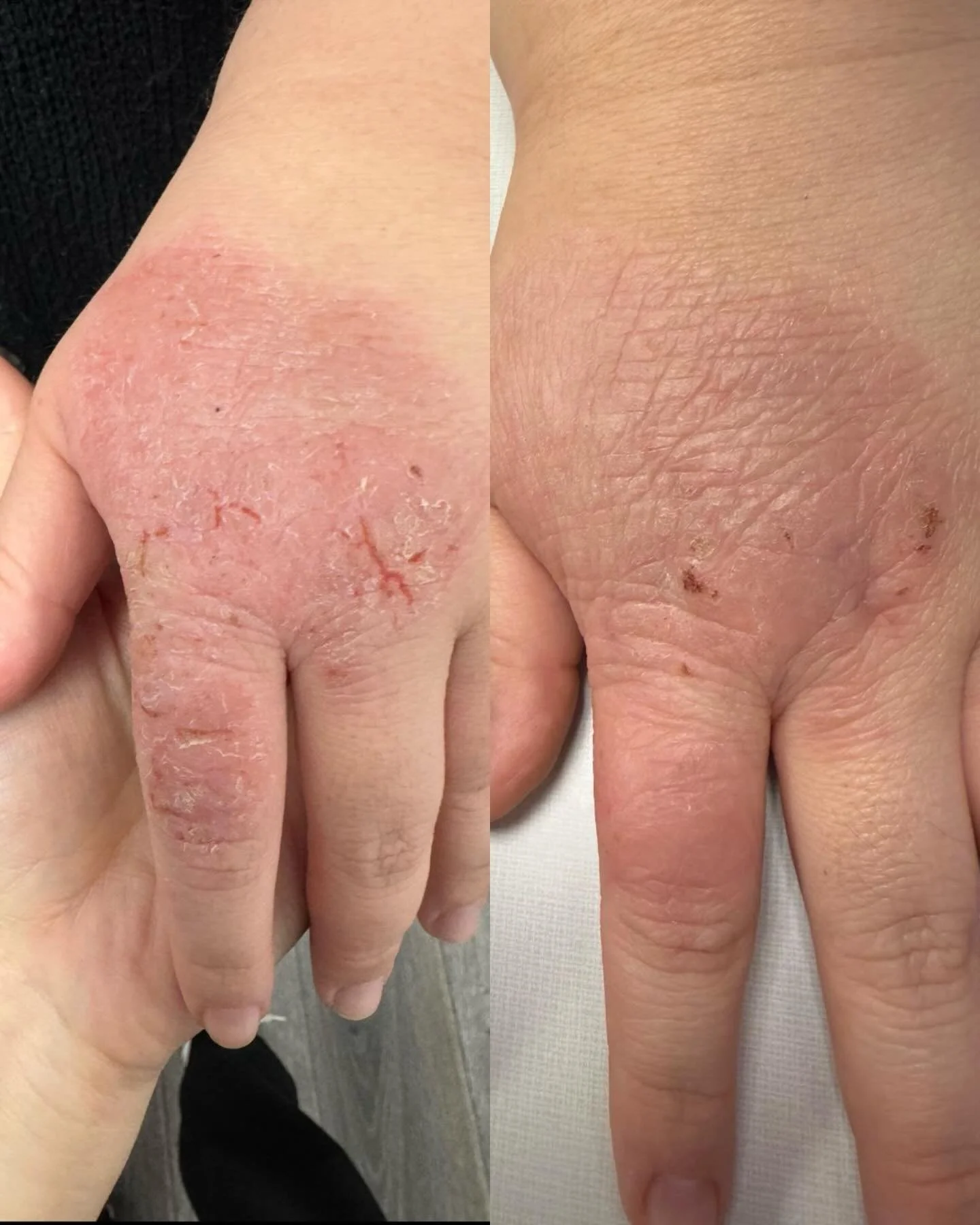 INFLAMED > CALM

We are SO happy with her progress with her second treatment 🥹✨

Aerolase has been helping calm her eczema by gently reducing inflammation and redness without harsh topicals or downtime.

This 1064nm energy targets inflammation de
