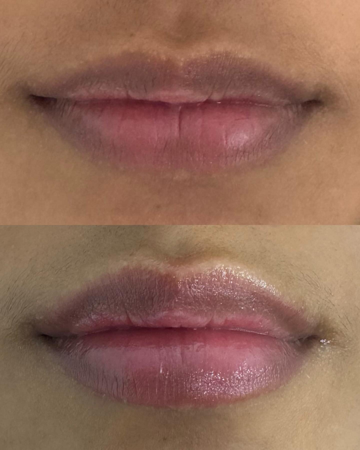 your lips just better 👄

these results are right atter her treatment

NO NEEDLES
NO PAIN
NO DOWNTIME
NO NUMBING CREAMS

The Aerolase Neo lip plump restores natural color, boosts hydration, and enhances volume&hellip;no needles, just RESULTS.

Questi
