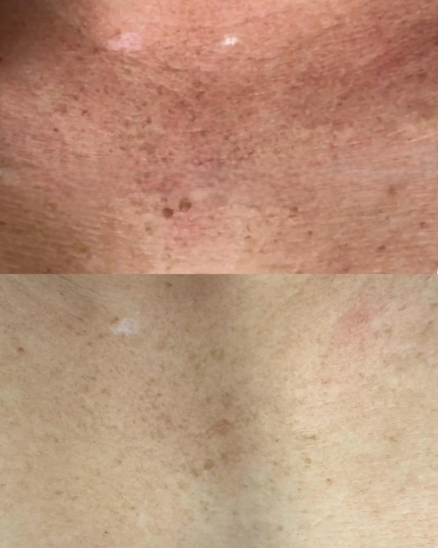 Your skincare doesn&rsquo;t stop at your jawline 💅🏽

Your chest is one of the first places to show aging&hellip; don&rsquo;t ignore it. At JFB, we can fix that ✨ 

Aerolase treats, sun damage, discoloration, texture, and more. 

We are SO happy wit