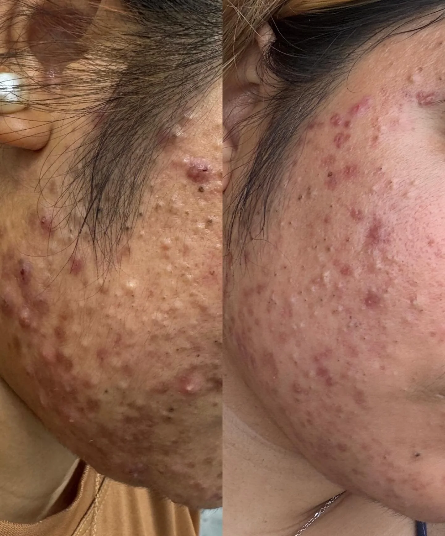 Progress in motion 🙌🏽

We&rsquo;re not done yet but this is what consistency and commitment look like. Treating with Aerolase Neo Elite + staying consistent with her @mariniskinsolutions homecare is getting her closer to her goal.

Trust the proces