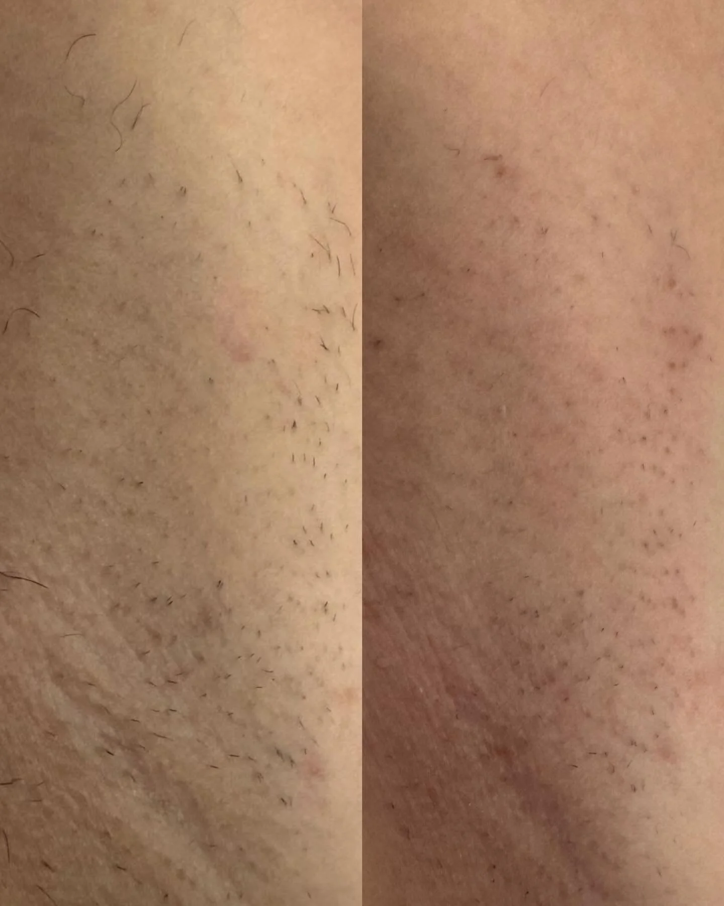 Ditch the razor and get laser 🔥

It&rsquo;s not just about being hair-free it&rsquo;s about better skin too. 

Aerolase also helps reduce ingrown hairs, improves discoloration, and minimizes dark spots for a smoother, more even tone.

Less shaving =