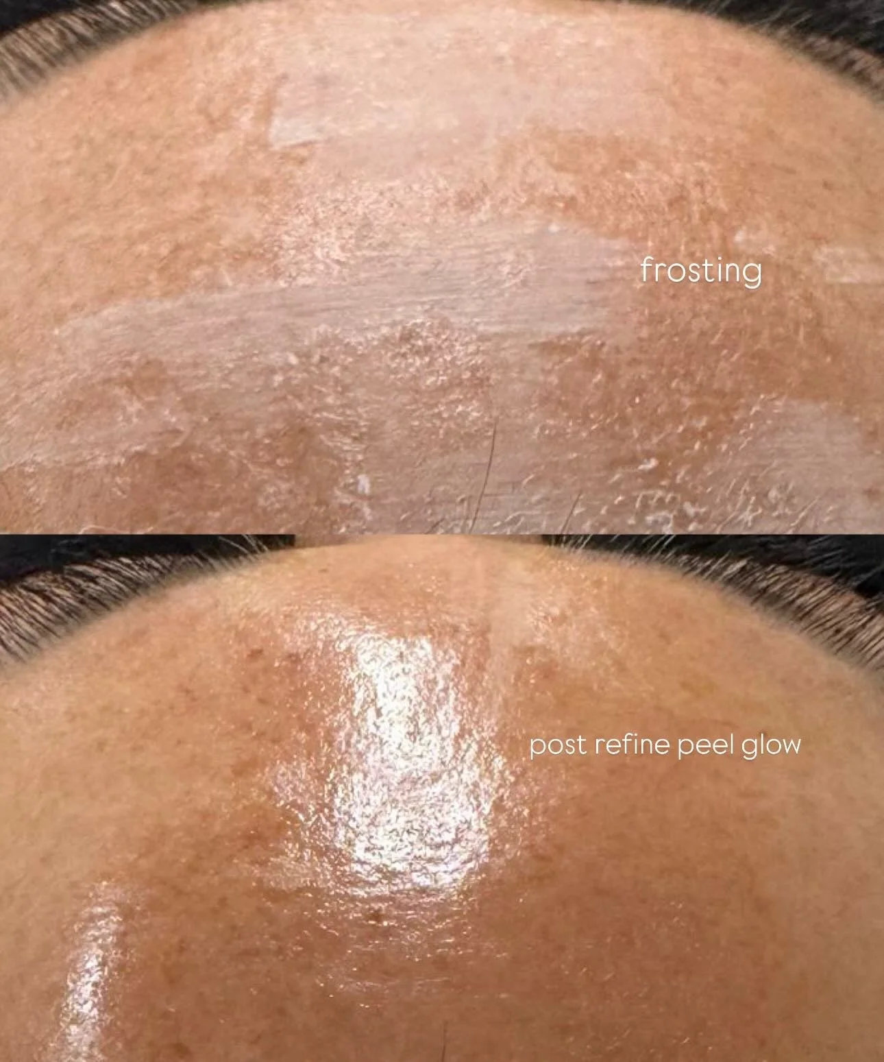 Chemical Peel &ldquo;Frosting&rdquo; 

That white &ldquo;frosting&rdquo; you see during a peel is a completely normal response called protein coagulation, it means the active ingredients are working on the skin at a controlled, targeted level. Frosti