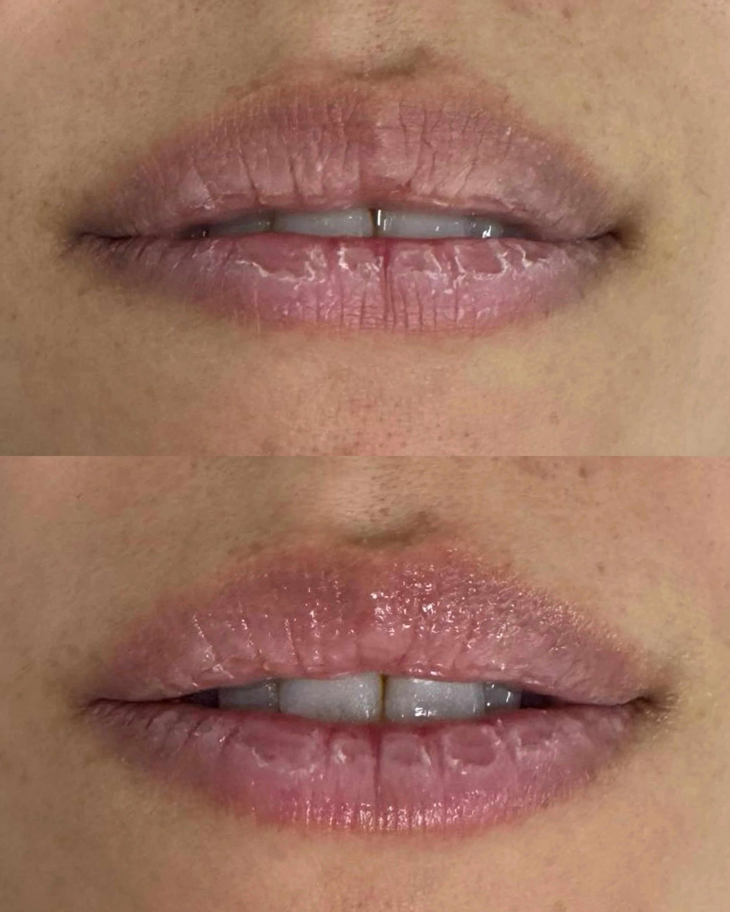 Your lips age too... but nobody talks about it

The Aerolase Neo Elite helps rejuvenate the lips by boosting collagen, improving texture, softening smoker&rsquo;s lines, and enhancing natural lip tone, all with a quick, comfortable treatment and no d