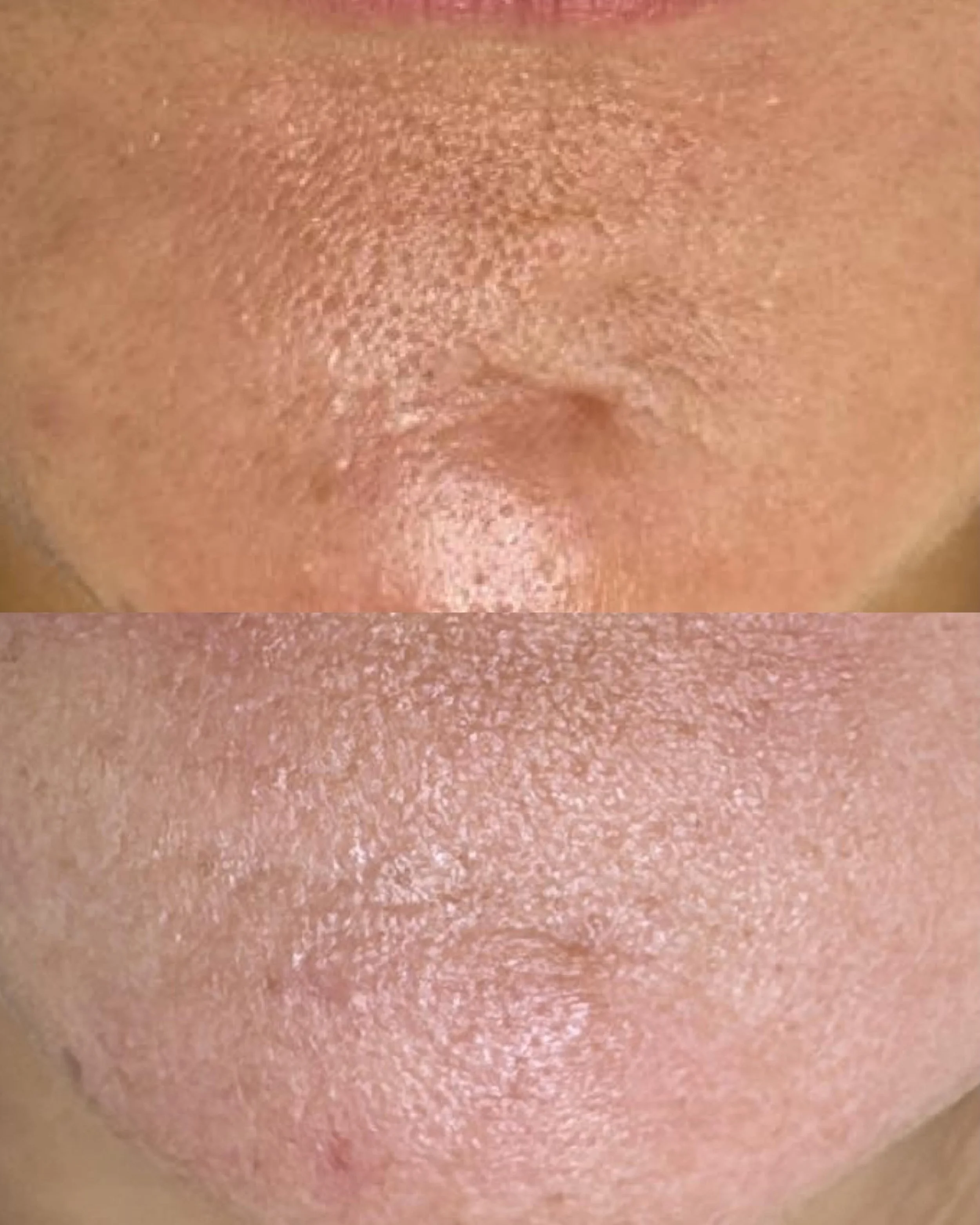 Aerolase treatments every 4 weeks helping to smooth scarring, refine pores, and improve overall skin texture.

Results like these don&rsquo;t happen overnight but they do happen with consistency and the right treatment plan.

Smoother. Clearer. Healt