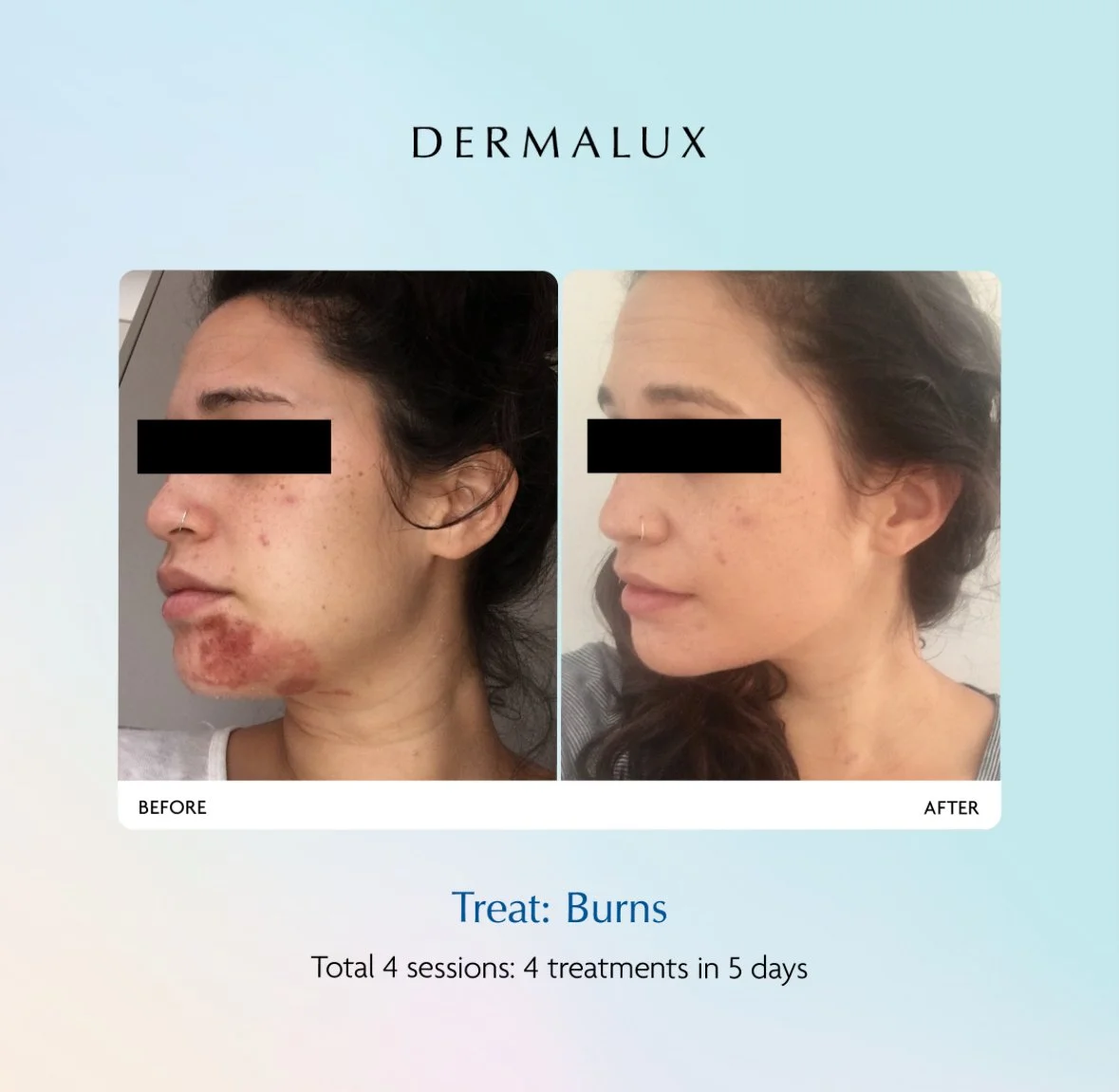 Treatment Dermalux Tri Wave MD LED Before & After. Medical grade LED effectively treats burns. At Luxe Lavish Health & Beauty Clinic, Newtown.