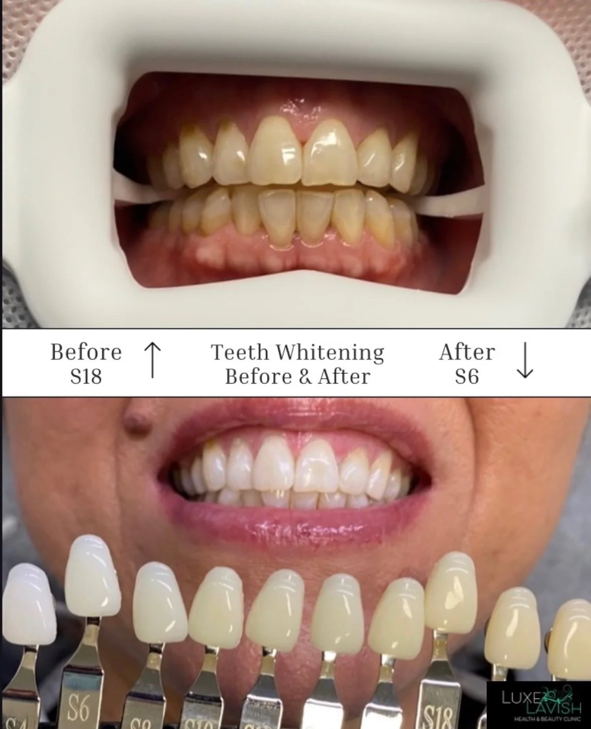Treatment Teeth Whitening Before & After treatment. At Luxe Lavish Health & Beauty Clinic, Newtown.