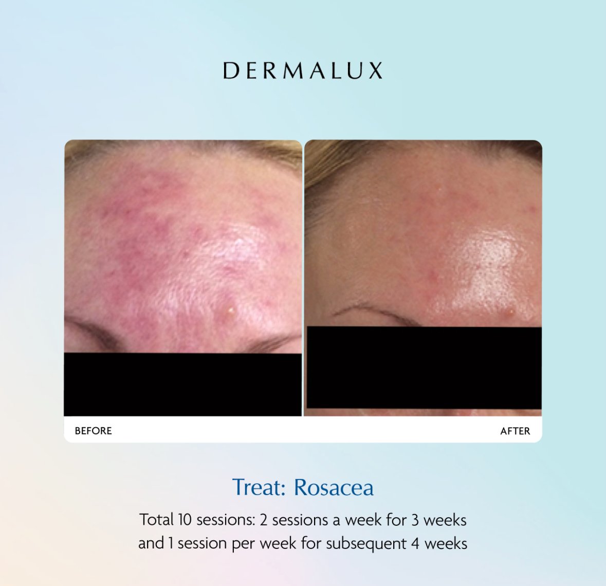 Treatment Dermalux Tri Wave MD LED Before & After. Medical grade LED effectively treats rosacea. At Luxe Lavish Health & Beauty Clinic, Newtown.