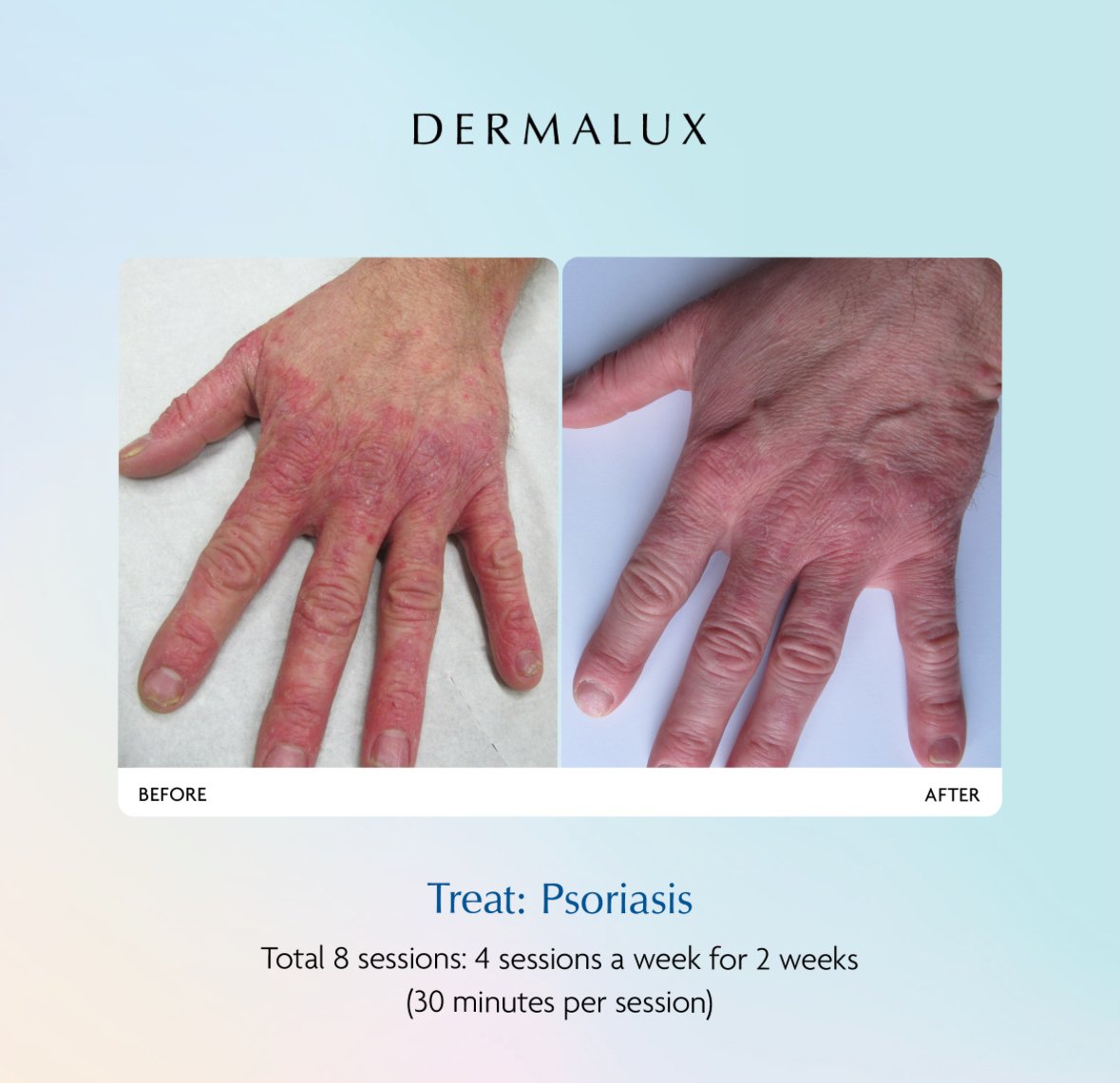 Treatment Dermalux Tri Wave MD LED Before & After. Medical grade LED effectively treats psoriasis. At Luxe Lavish Health & Beauty Clinic, Newtown.