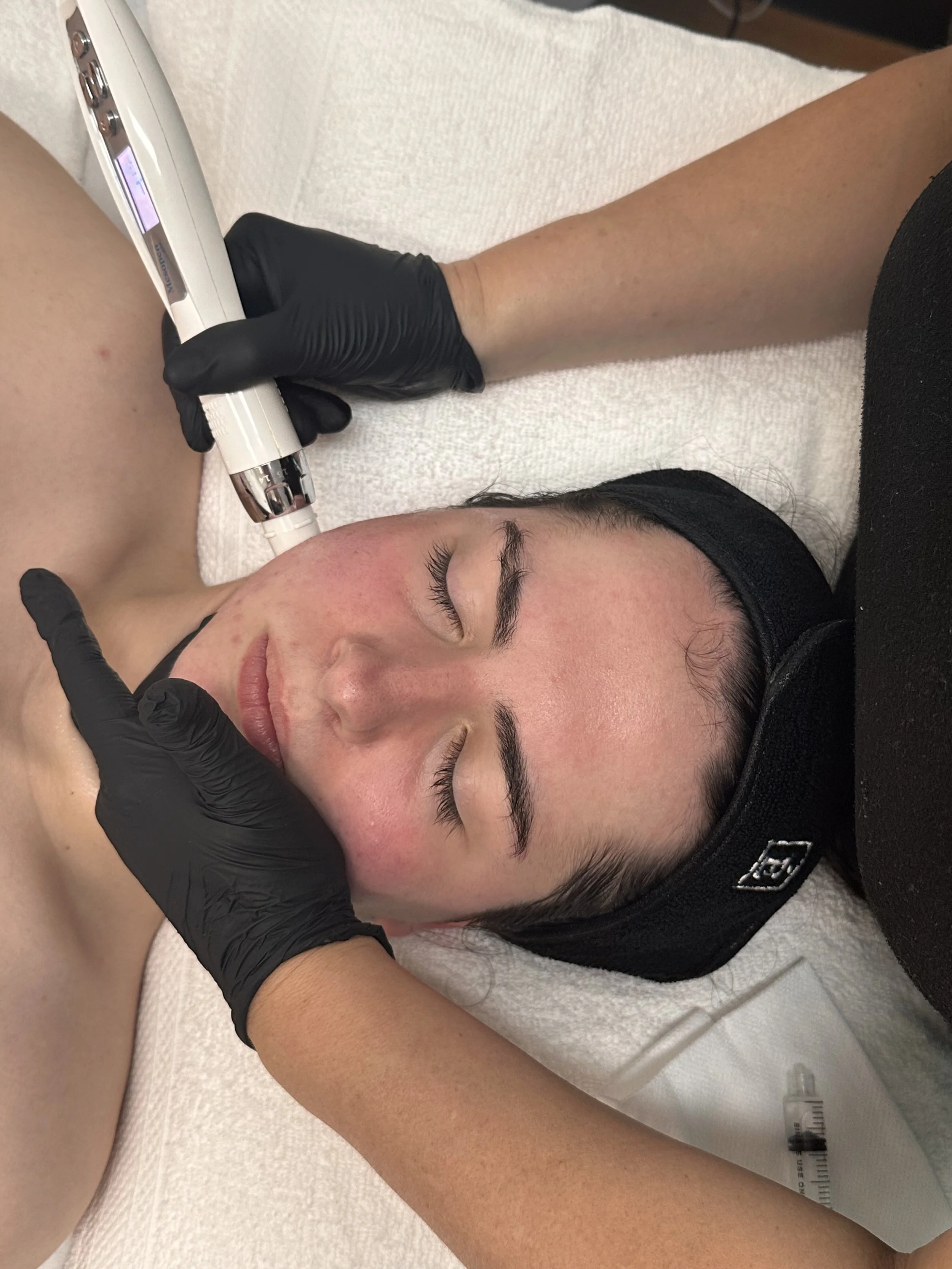 Mesopen Pro Advanced Skin Needling, Newown, Sydney