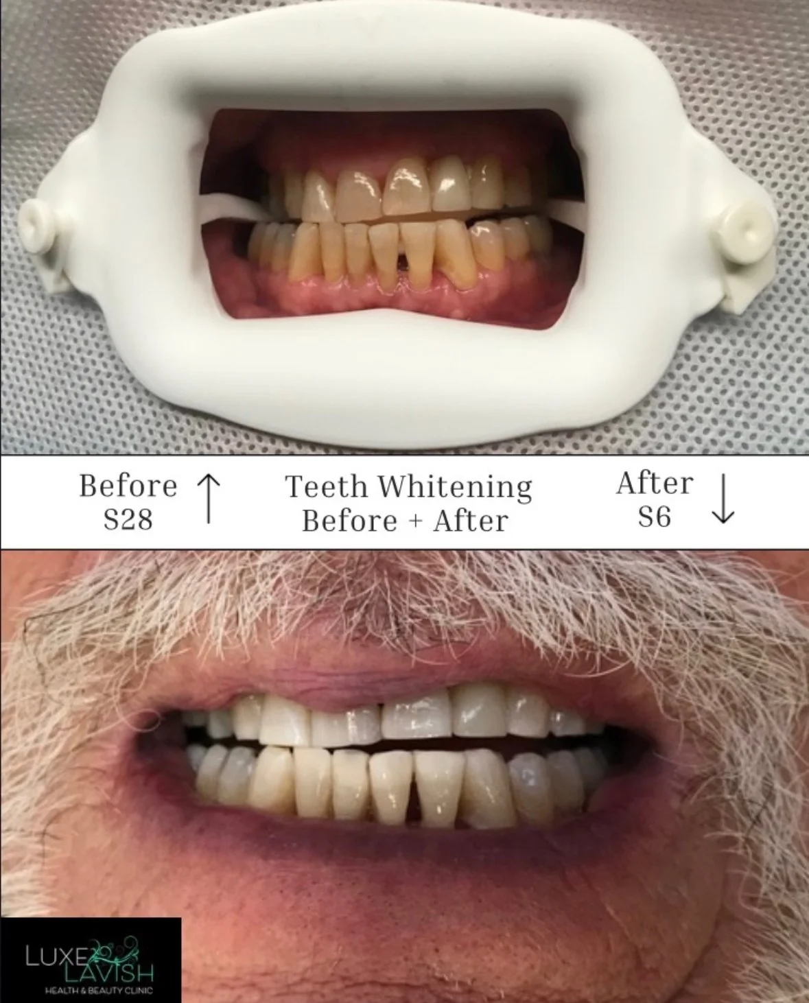 Treatment Teeth Whitening Before & After treatment. At Luxe Lavish Health & Beauty Clinic, Newtown.