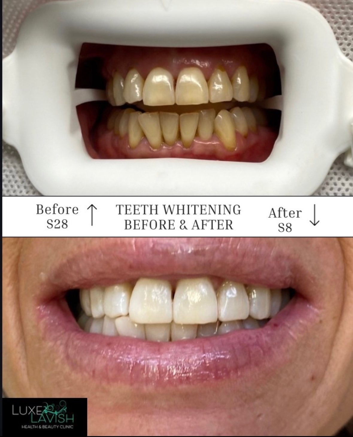 Treatment Teeth Whitening Before & After treatment. At Luxe Lavish Health & Beauty Clinic, Newtown.