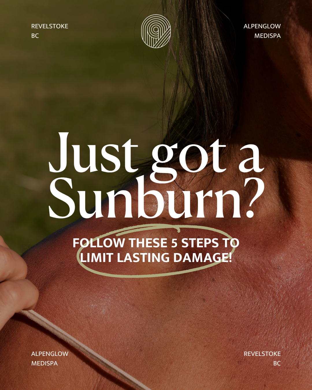 Alpenglow - Sunburn Survival Guide (1).png