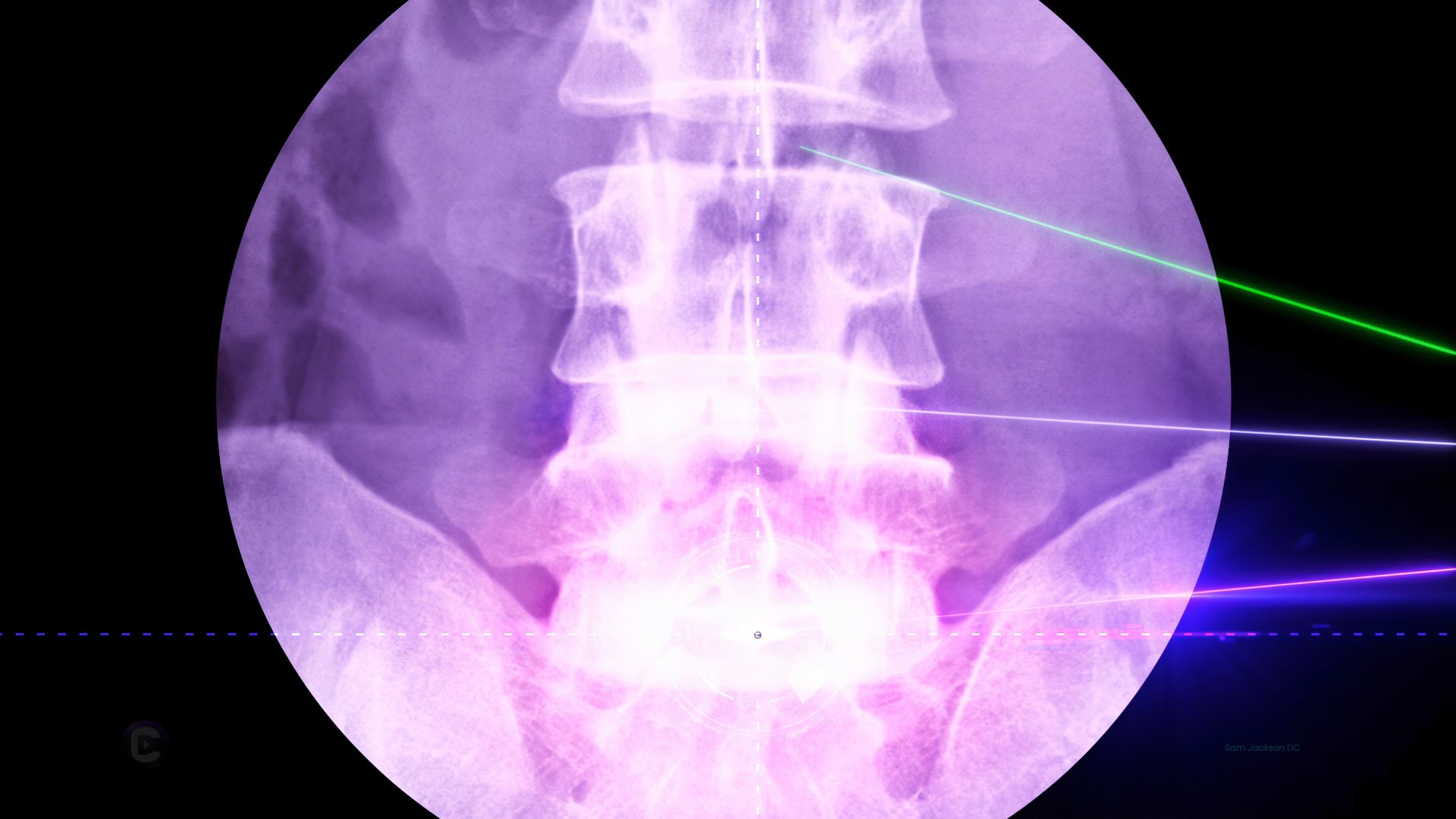 SpineLab Radgiographically guided discography. Picture showcases precise imaging technique for evaluating spinal discs. Trust our expertise for accurate assessments..jpg