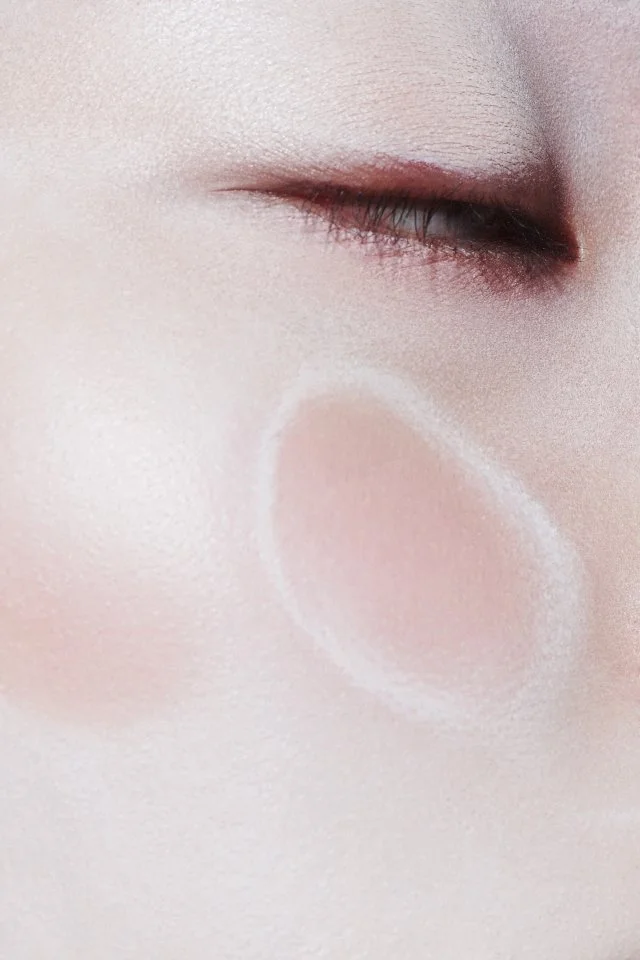 MIJN REIS VAN HUIDBLEKEN NAAR ZELFACCEPTATIE