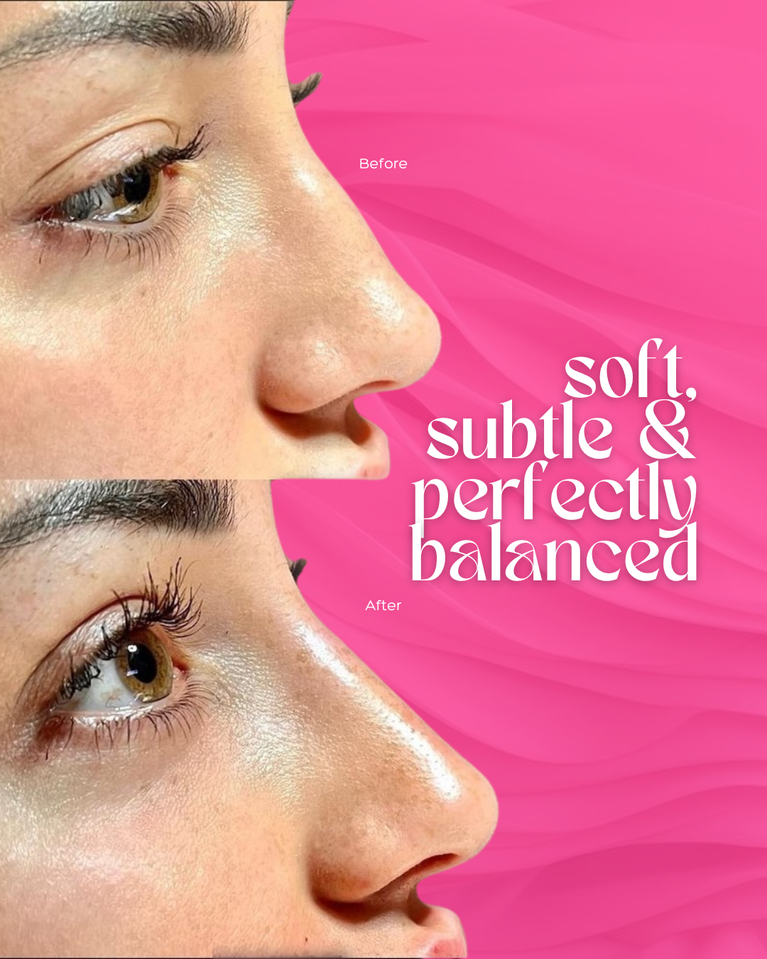 0221_NONSURGICALNOSE copy.png