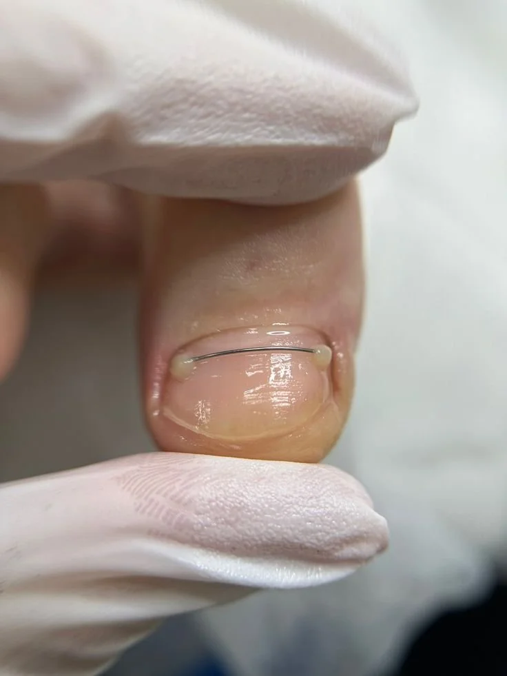 Podology services in New York City including nail restoration, ingrown nail correction, callus treatment, and advanced foot care with professional technique