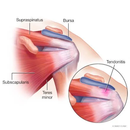 Rotator Cuff Tendinopathy: Why Your Shoulder Still Hurts — and What You Can Do About It