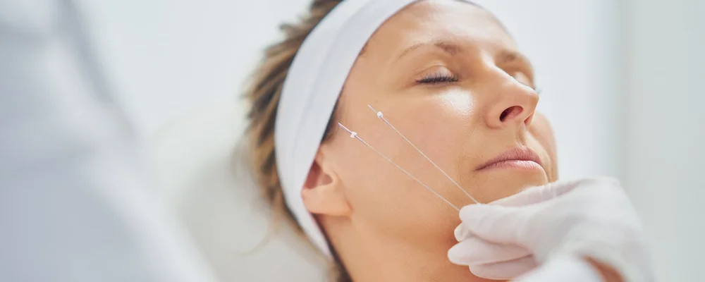 Threadlifting PDO Thread Lift - Non-Surgical Face Lift — Athena Dermatology Clinic