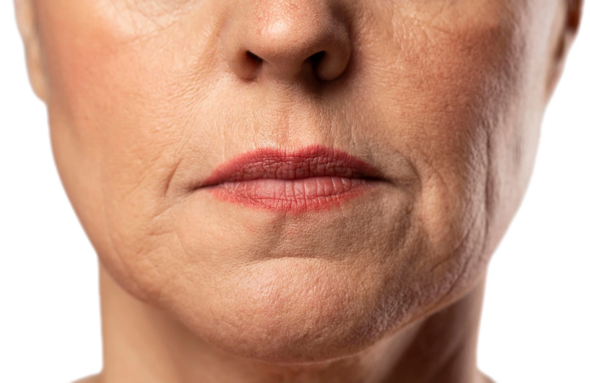 Athena - anti wrinkle Injection