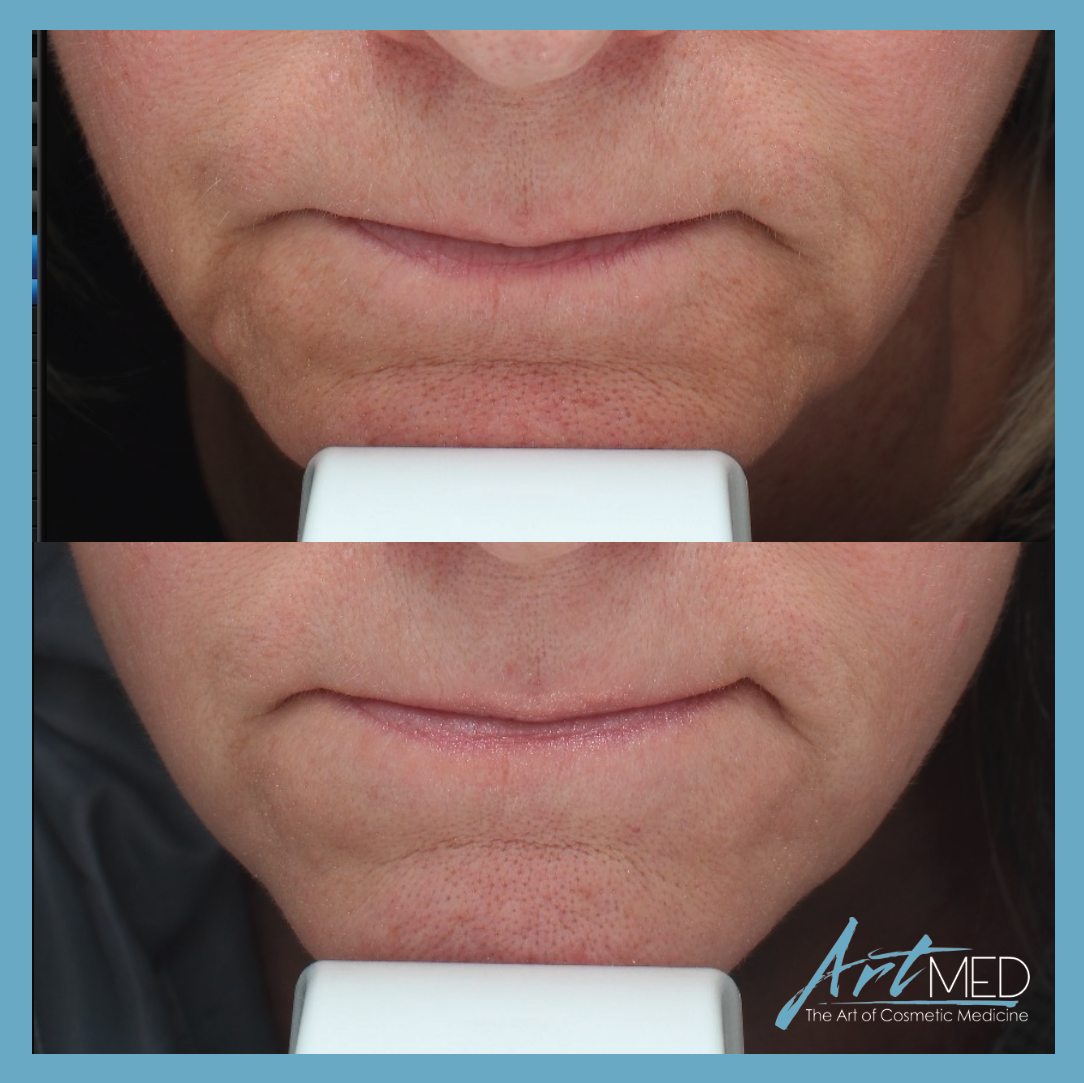 Sofwave™ NonSurgical Face, Neck & Body Skin Tightening in Guelph