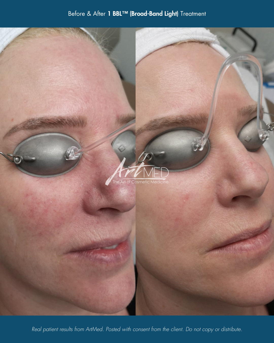 Before & After HALO Skin Tightening Treatments.png