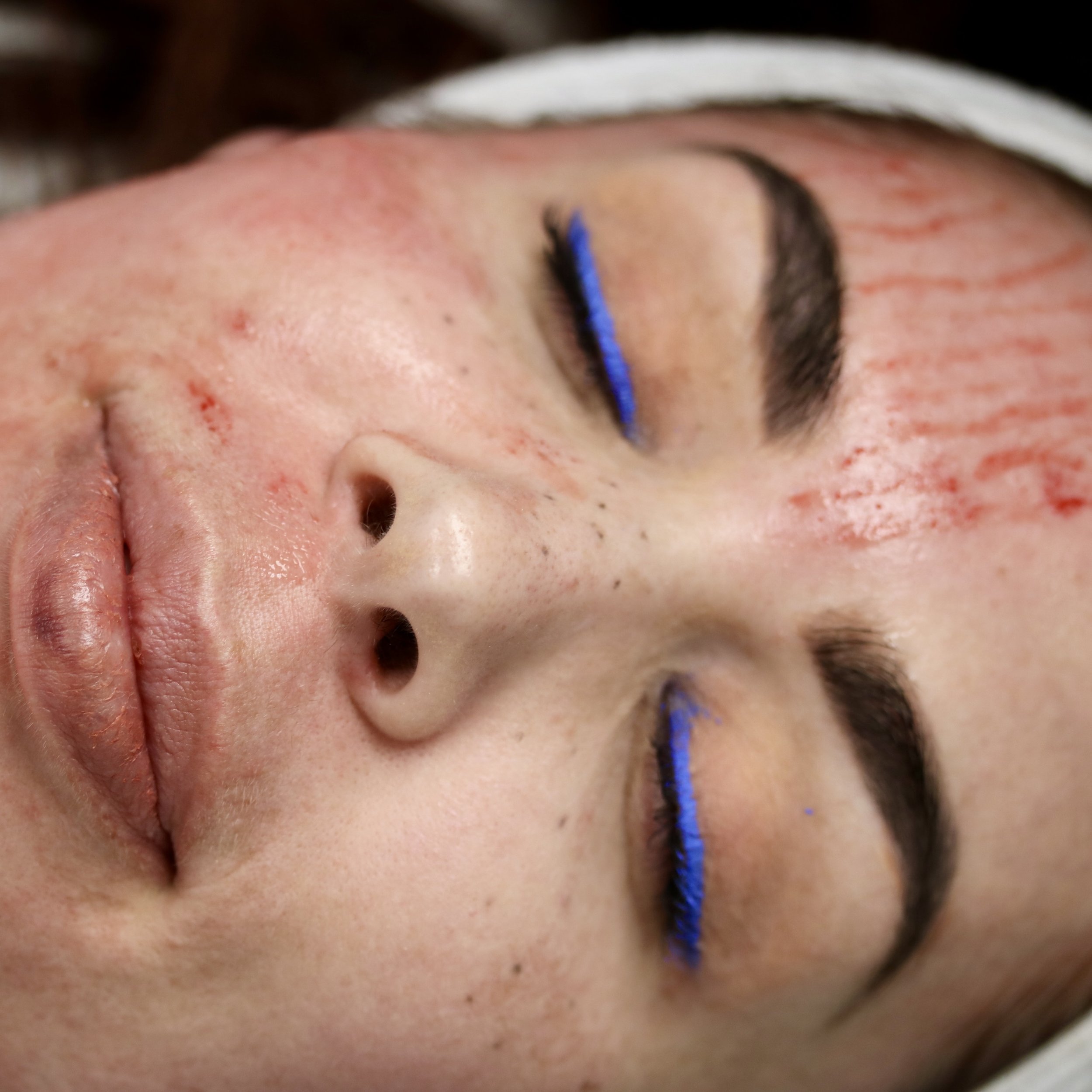 Ask Dr. Peirson – What is Microneedling?