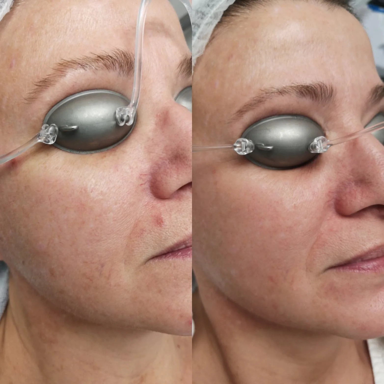 Ask Dr. Peirson – What is BBL™ Broadband Light?