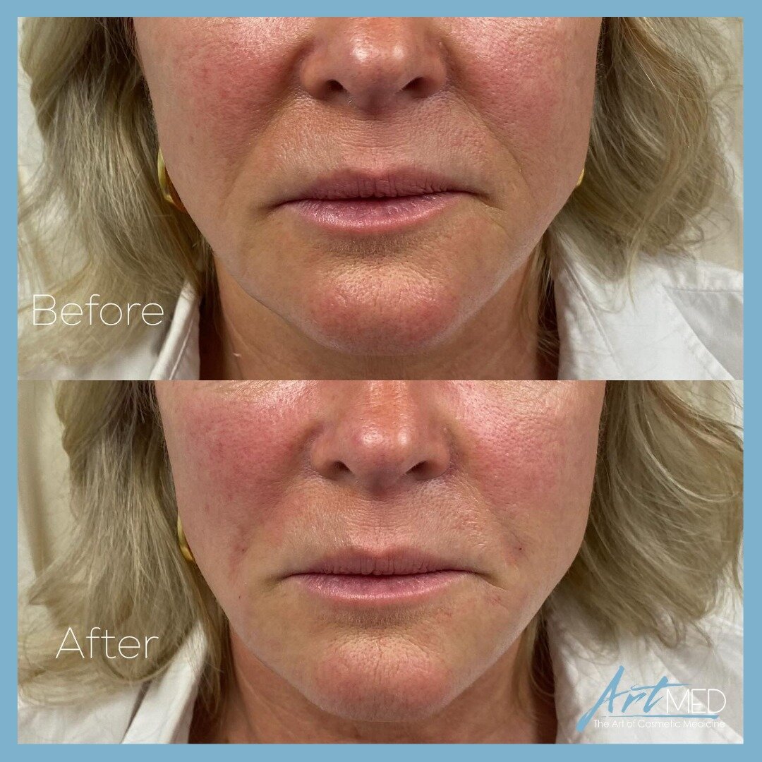 Before &amp; after nasolabial lines treatment by Nurse Morgan @_nursemorgan. 💙

Deep lines running from the nose to the corners of the mouth (nasolabial lines or NLs) is a common feature of aging. How to treat NLs is a frequent inquiry at ArtMed. 

