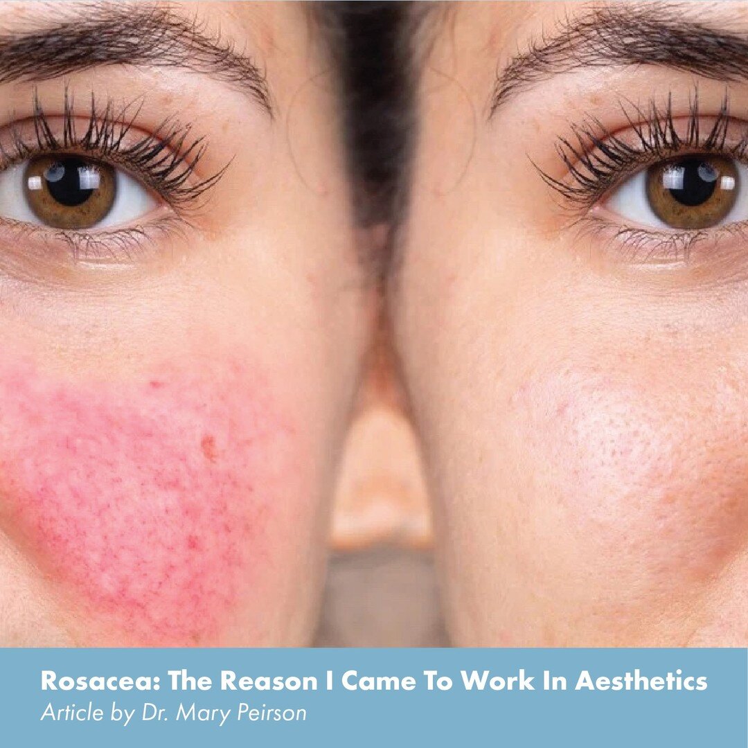 April is #RosaceaAwarenessMonth. 
 
In this article, Dr. Peirson shares a bit about her personal relationship with rosacea and why it led her into the industry of medical aesthetics. 
 
&quot;A lot of people ask me how I came to be working in medical