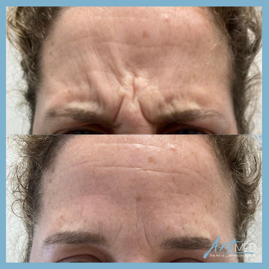 Neurotoxin results for frown lines. 😠 This client is frowning in both pictures!
⁣⁣
Typically approximately 20-25 units are needed and voila! BOTOX&reg; and XEOMIN&reg; both take effect within a few days of being treated and last for 3-4 months.⁣⁣ 😊