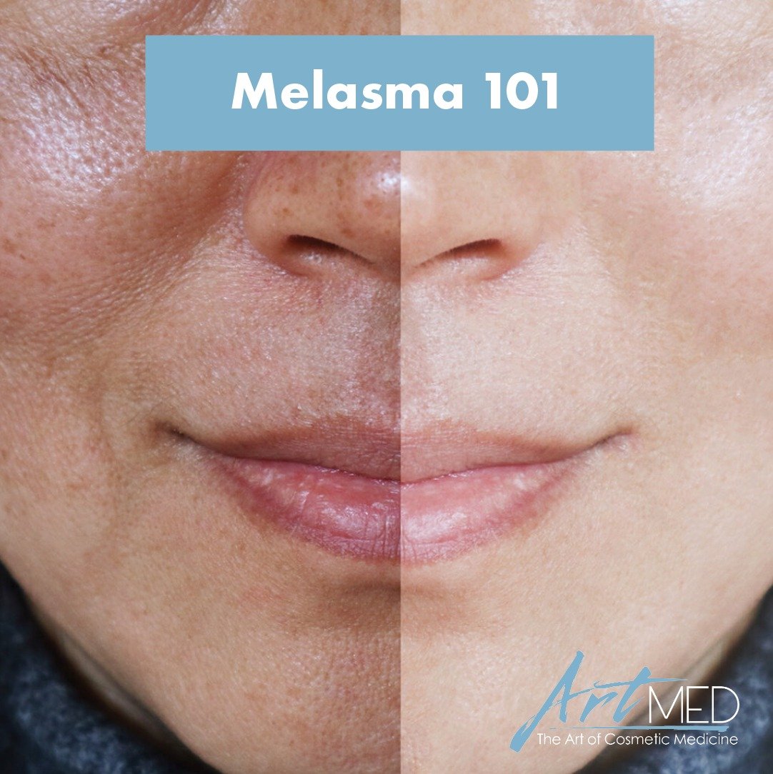 &ldquo;Melasma&hellip; sigh. 

If you suffer from melasma you&rsquo;ll know what I mean. Melasma is a hyper-pigmentation skin condition that is annoyingly chronic and difficult to treat. It strikes mostly women starting in their 20&rsquo;s or 30&lsqu