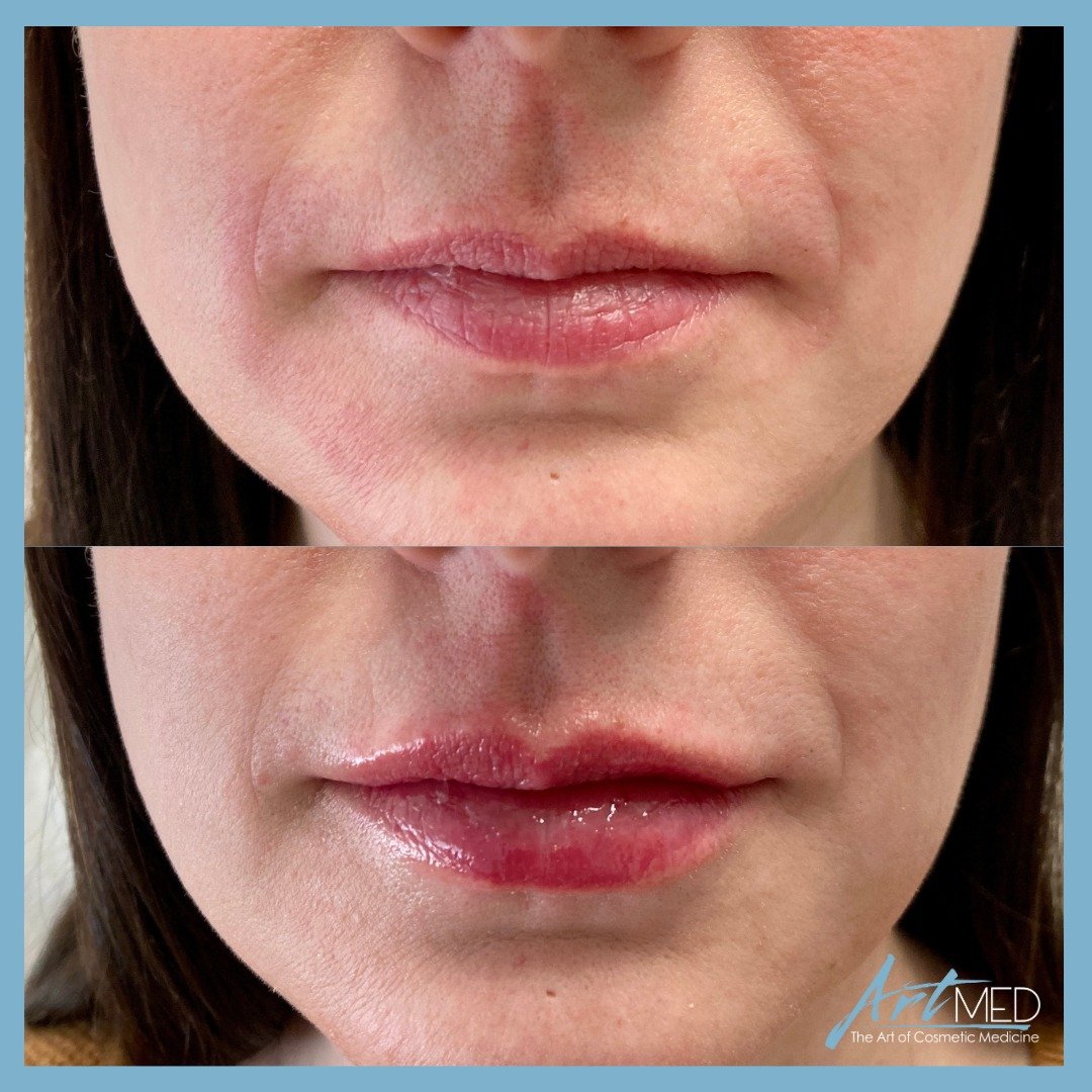 Before &amp; after lip filler for a lovely client. Treatment was provided by Nurse Sarah (@cosmetics.by.sarah)! ✨💙 
 
This beautiful transformation was achieved using 0.6ml of Revanesse Ultra dermal filler. Nurse Sarah&rsquo;s technique helped to ba