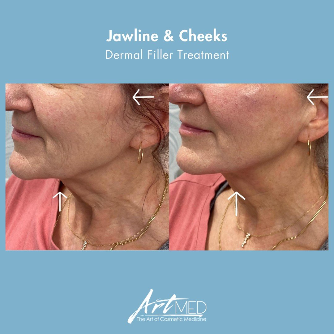 Enhancing facial harmony with precision! 🌟 

Lower face issues such as marionette lines, jowling and jawline laxity are often worsened by loss of volume in the midface. An expert injector will recognize this and address it accordingly. 

In this cas