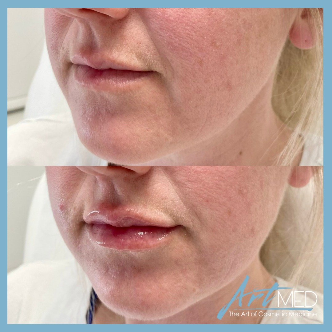 💋✨ Subtle, stunning lip transformation! 

Witness the journey of our lovely client, who received gradual enhancements with 1/2 a syringe of Revanesse Ultra dermal filler each session (1 syringe in total over the last year), ensuring a flawless, natu