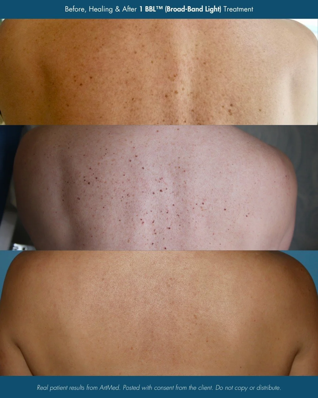 BBL&trade; Season is here! ✨

After a summer of sun, now&rsquo;s the perfect time to treat sun damage, redness, and stubborn pigmentation. BBL&trade; (BroadBand Light) works below the surface to restore clearer, more radiant skin - and the results sp