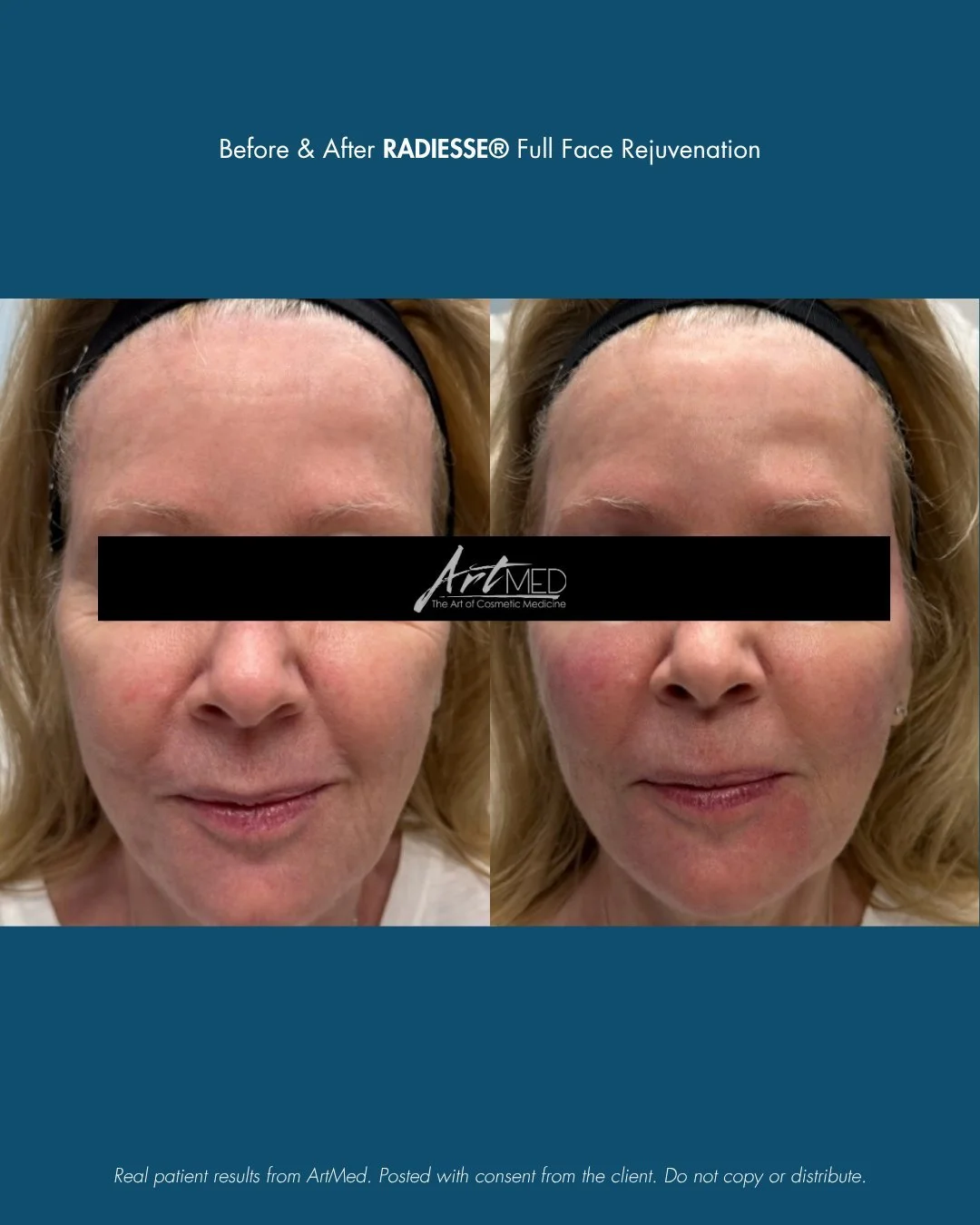 💉 Full-Face Rejuvenation with Radiesse&reg;

Radiesse&reg; isn&rsquo;t your typical filler - it&rsquo;s a biostimulator that helps your skin rebuild its own collagen and elastin for firmer, more youthful structure that lasts.

✨ Immediate lift. Long