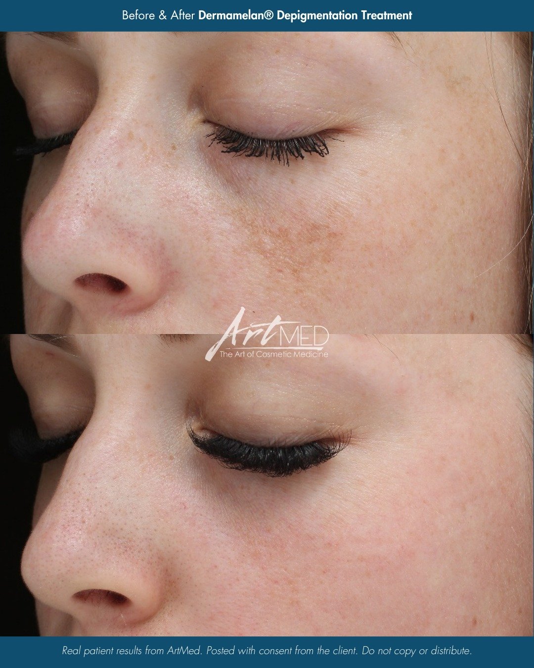 Dark spots don’t stand a chance. ๐ฅ
Dermamelan® is the gold-standard depigmentation peel that fades stubborn pigmentation including melasma, sun damage, and post-acne marks while revealing smoother, radiant, more even-toned skin.
โจ Why pat