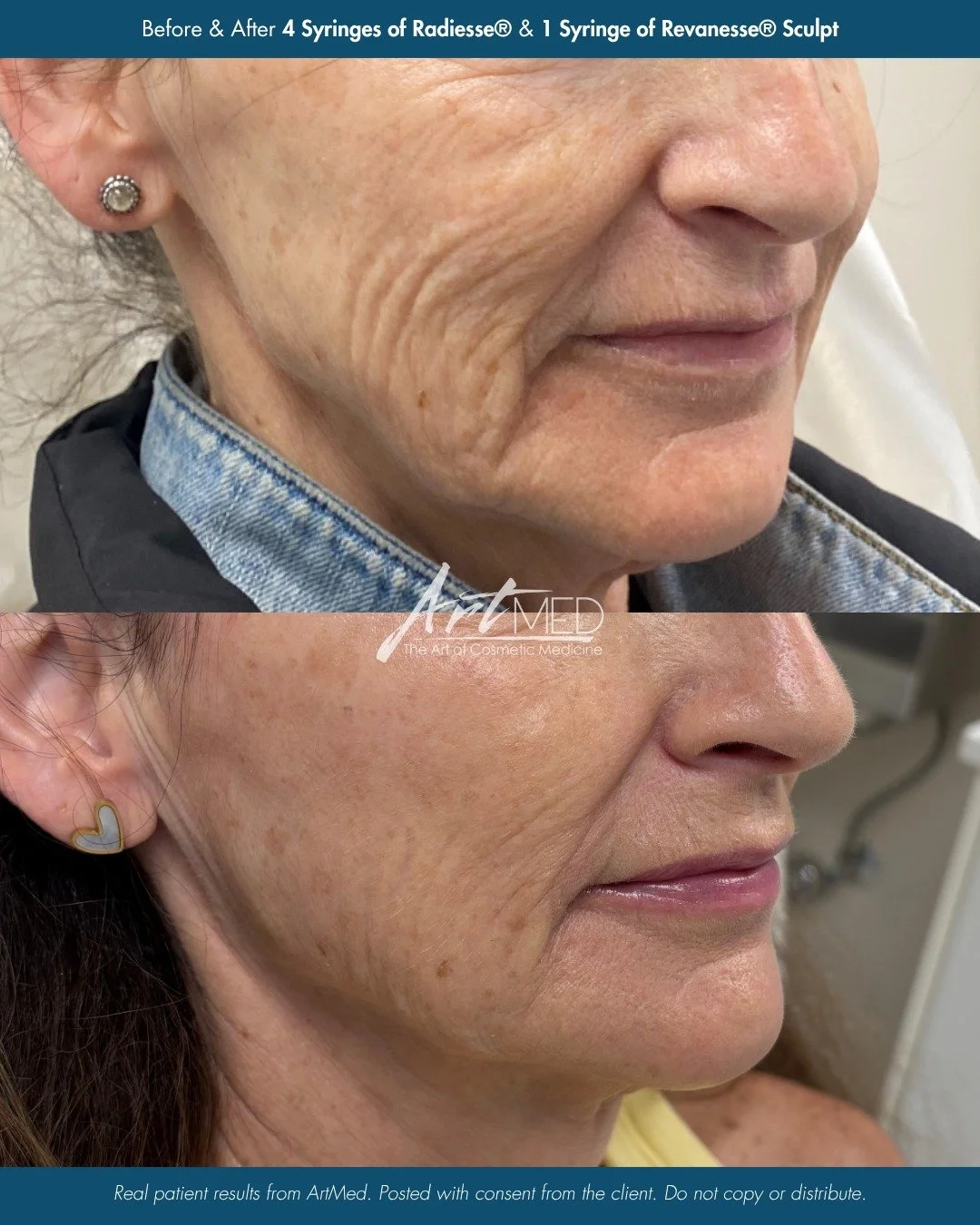 The power of bio-stim filler. ✨
 
This stunning transformation was achieved through a personalized, year-long treatment plan provided by Nurse Morgan (@_nursemorgan).
 
💉 Treatment Details:
&bull; 4 syringes of Radiesse&reg; bio-stimulatory filler t