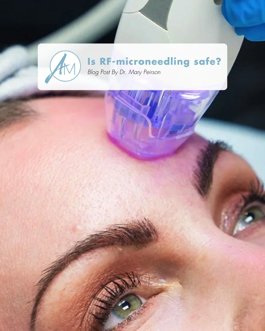 There&rsquo;s been a lot of conversation on social media lately about RF (radio-frequency) microneedling. While it&rsquo;s a popular treatment elsewhere, it&rsquo;s not something we offer at ArtMed. Based on Dr. Peirson&rsquo;s extensive research, we