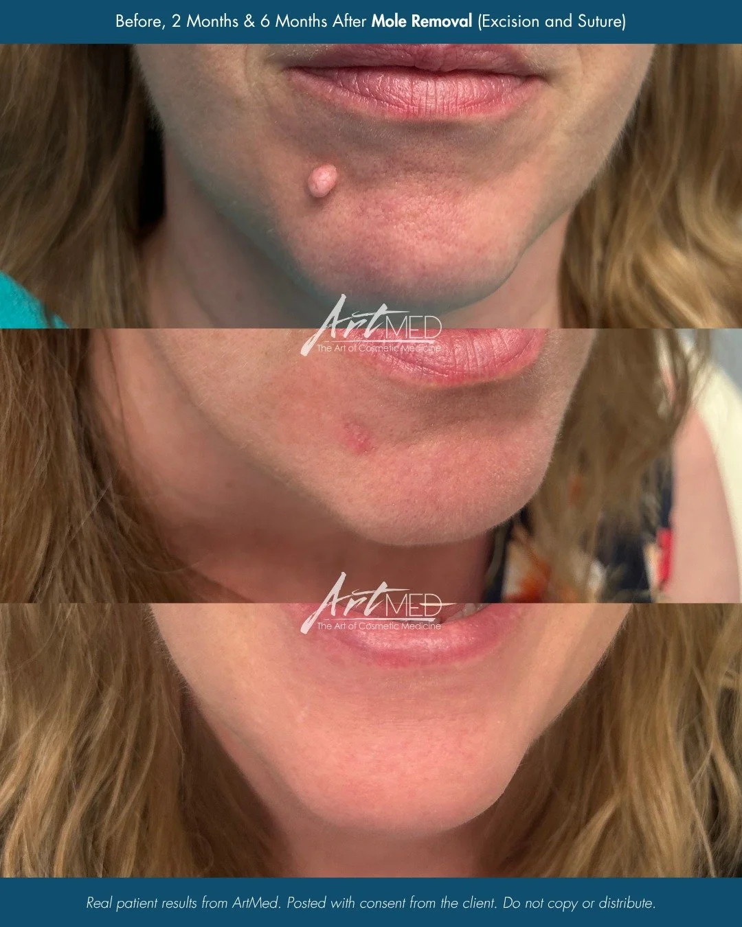 Thinking about mole or lesion removal? 

Our Nurse Practitioner Ingrid has advanced training in surgical procedures with a special interest in removing benign lesions.

Here&rsquo;s how it works:
1️⃣ Upload a photo on our website (link in bio)
2️⃣ Re