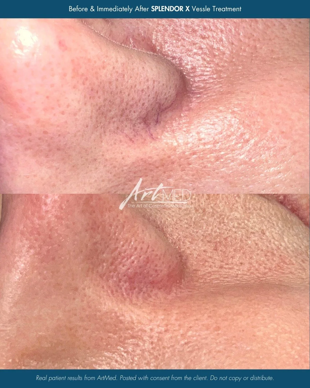 Stubborn veins? Splendor X has you covered. ✨

This fast, effective, and comfortable laser treatment targets unwanted vessels with precision - delivering visible results you&rsquo;ll love.

If you&rsquo;ve been thinking about treating facial veins or