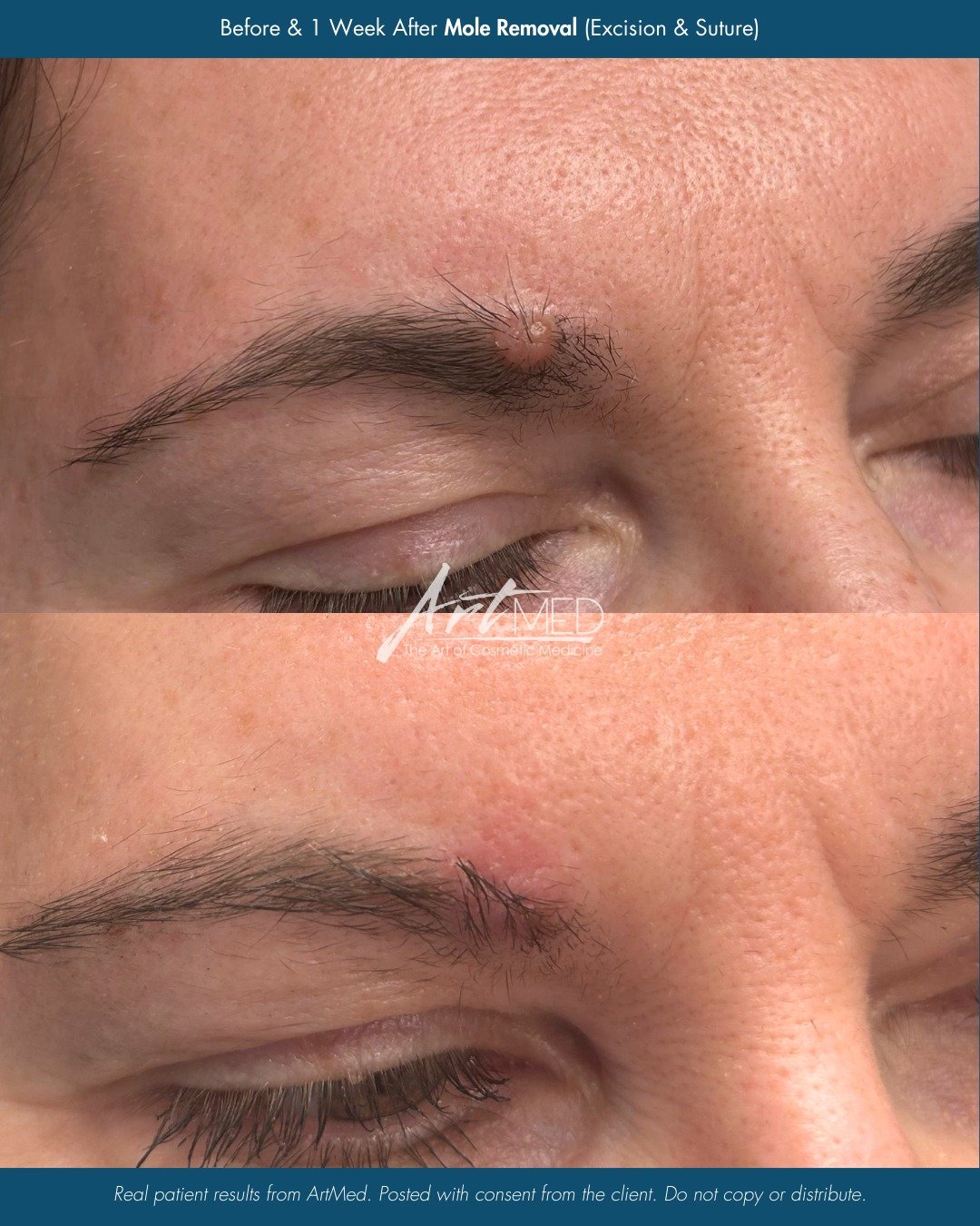 Did you know we offer mole, cyst, skin tag, and lesion removal at ArtMed? 🤔 These before &amp; afters are all from recent lesion removal procedures provided by our talented Nurse Practitioner Ingrid.

Do you have a skin lesion you&rsquo;d like to ha