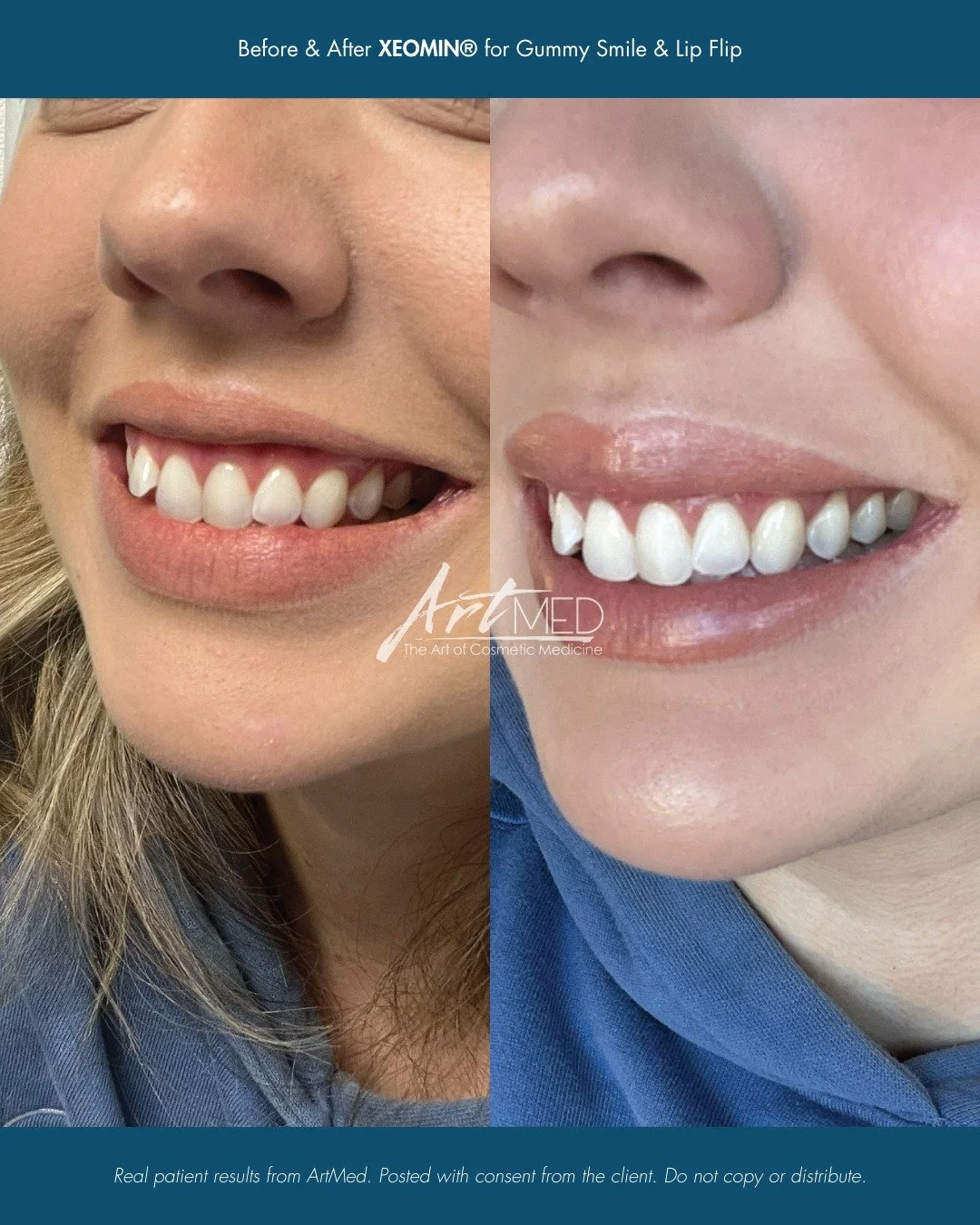 Looking to enhance your lips but not ready for lip filler? 
A lip flip with gummy smile treatment may be the perfect option. 

Using small, precise amounts of neurotoxin (Botox or Xeomin), we can gently relax the muscles around the upper lip. This al