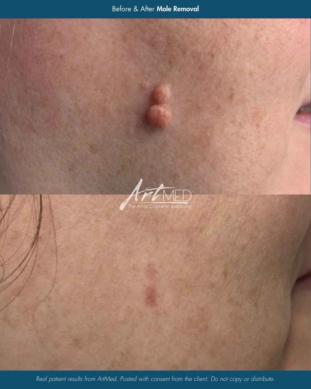 Before &amp; After: Benign Mole Removal ✨

This transformation shows the removal of a large, coin-sized benign mole cluster on the cheek, performed by NP Ingrid. Ingrid has advanced surgical training and RNFA certification, with a special interest in
