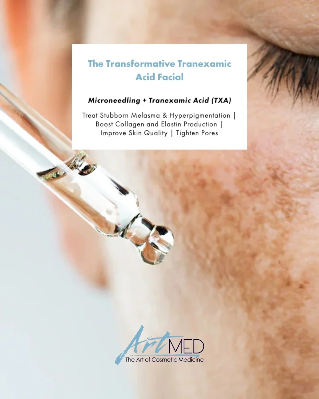 The Transformative Tranexamic Acid Facial: Microneedling + Tranexamic Acid (TXA) ✨

Struggling with stubborn pigmentation or melasma that just won&rsquo;t budge? Our newest advanced treatment is designed to target uneven tone at its source while impr