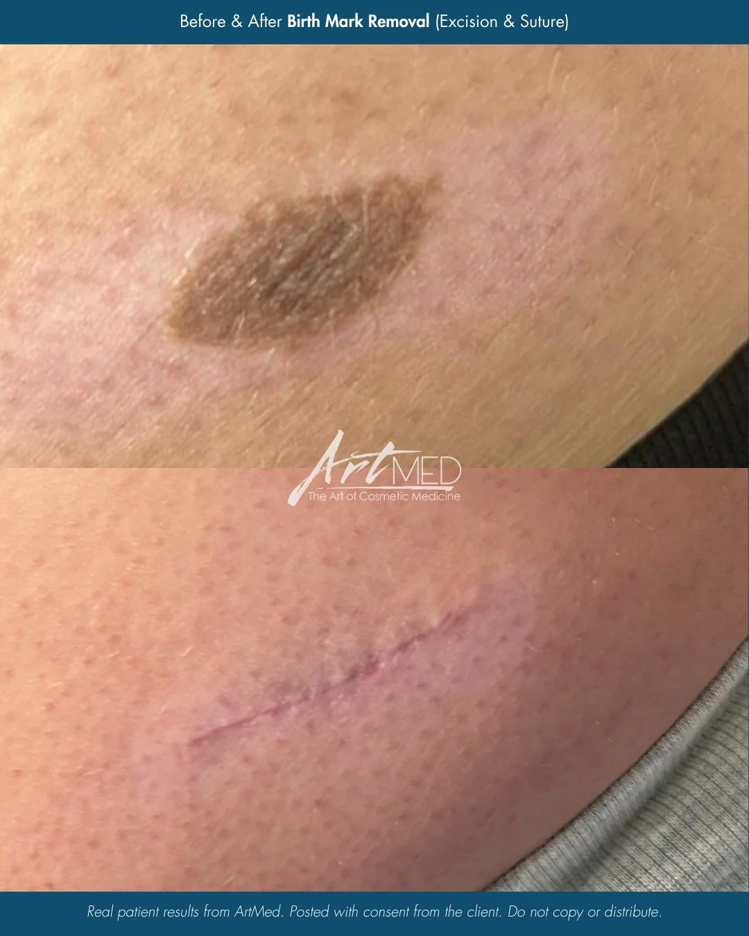 Results following birth mark removal with excision and suturing, performed by NP Ingrid.

This procedure is carefully planned to completely remove the lesion while prioritizing clean closure and optimal scar healing over time. As the area continues t